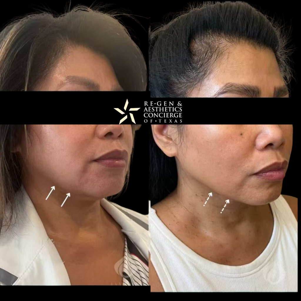 Non surgical facelift with XERF 2 XERF BEFOREAFTER PHOTOS 1 1