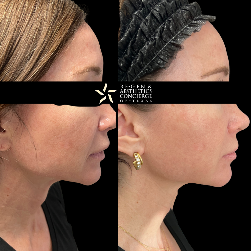 Non surgical facelift with XERF 3 XERF BEFOREAFTER PHOTOS 2 1