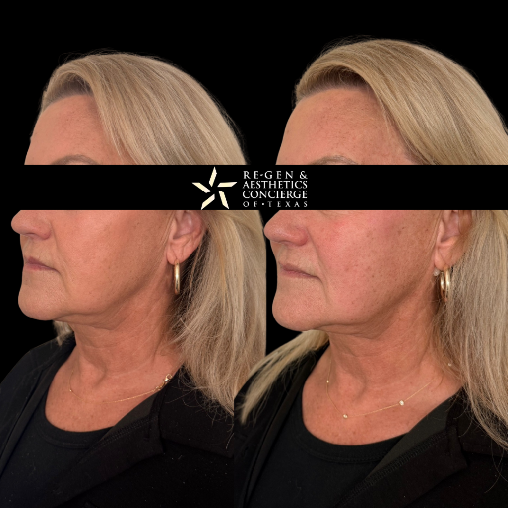 Non surgical facelift with XERF 1 XERF BEFOREAFTER PHOTOS 2