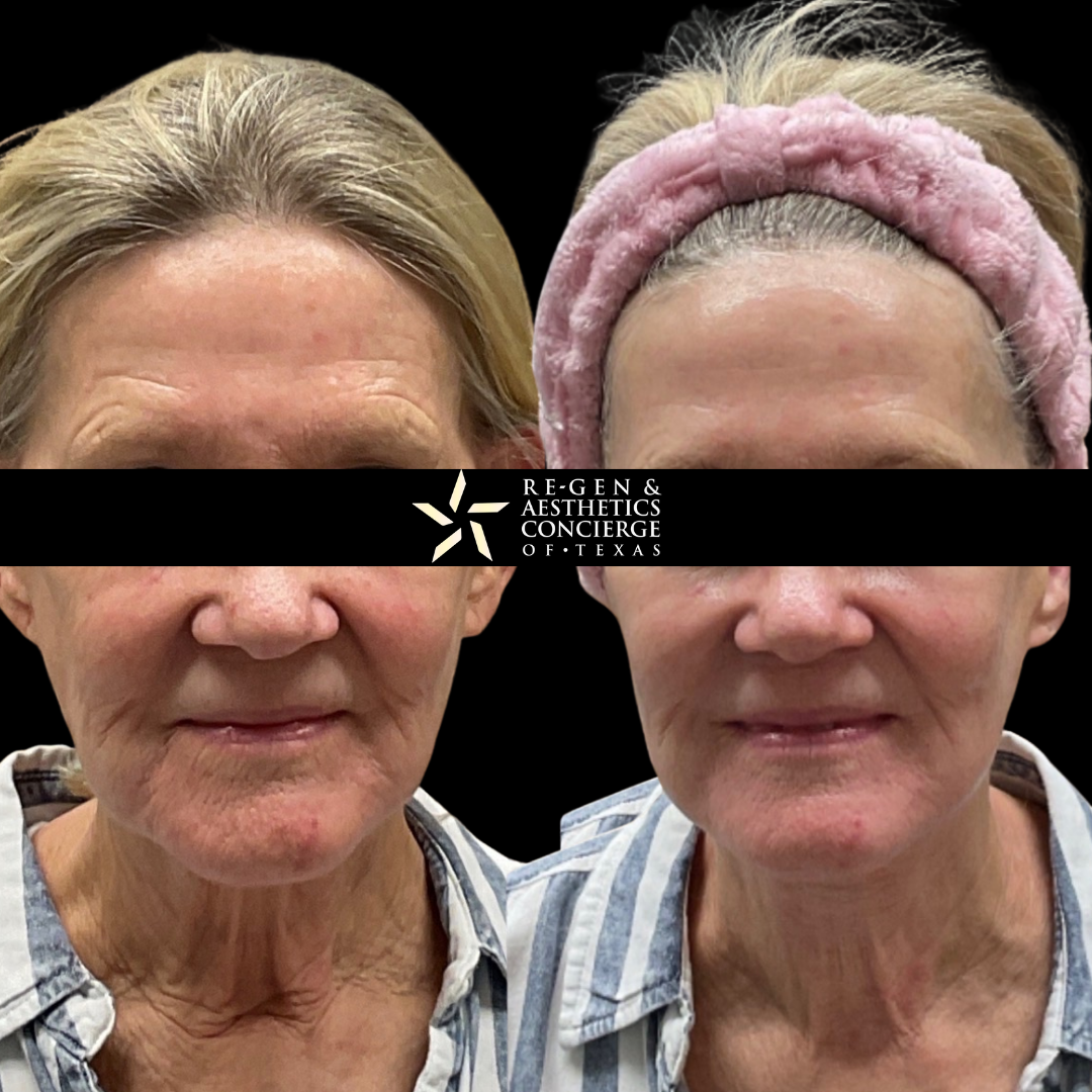 XERF BEFOREAFTER PHOTOS 3