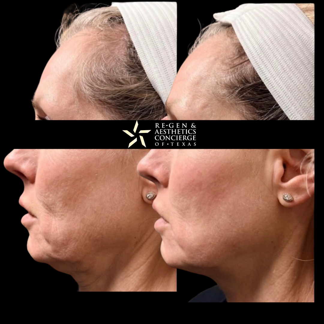XERF BEFOREAFTER PHOTOS 5