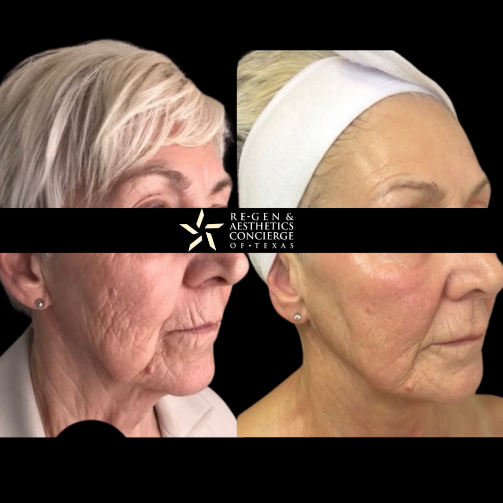 Non surgical facelift with XERF 8 XERF BEFOREAFTER PHOTOS 7