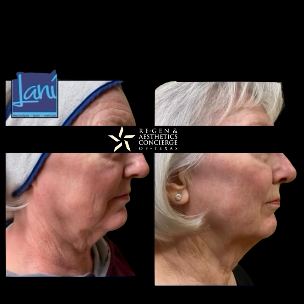 Non surgical facelift with XERF 9 XERF BEFOREAFTER PHOTOS 8
